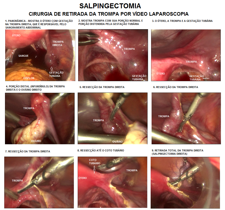 SALPINGECTOMIA_GESTA__O_TUB_RIA.png