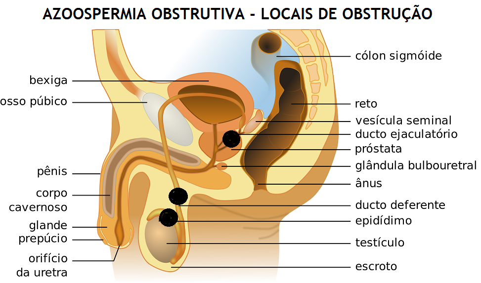 AZOOSPERMIA_OBSTRUTIVA_1.png