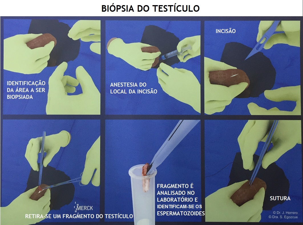 BIoPSIA_TESTICULAR.jpg