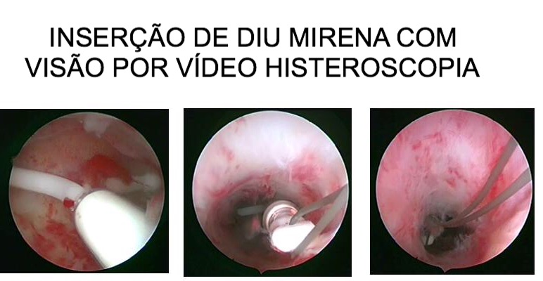 DIU_MIRENA_VIDEO_HISTEROSCOPIA.jpg