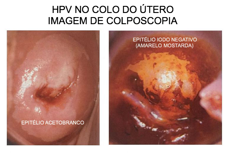HPV_COLO_DO_UTERO_COLPOSCOPIA_copy.jpg