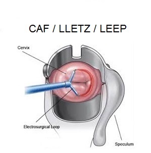 CIRURGIA_CAF_LLETZ_LEEP.jpg