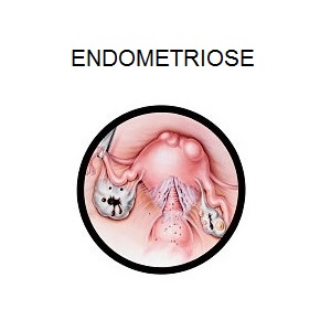 ENDOMETRIOSE_CAPA.jpg