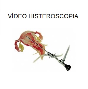 V_DEO_HISTEROSCOPIA.jpg