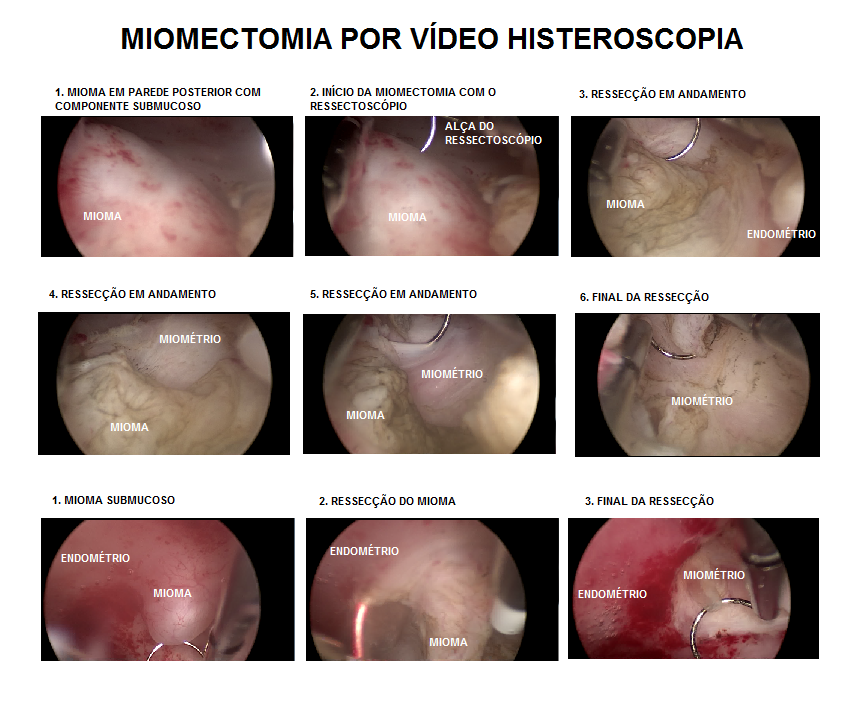 MIOMECTOMIA_POR_VIDEO_HISTEROSCOPIA.png