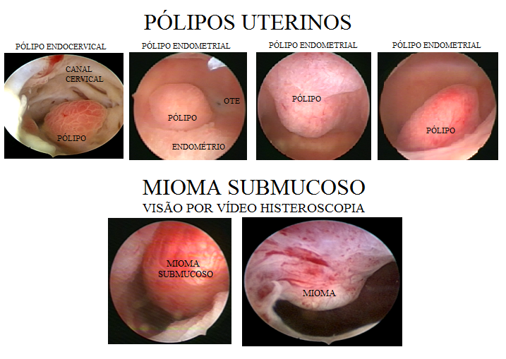 P_LIPOS_E_MIOMAS_UTERINOS.png