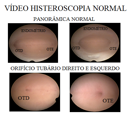 V_DEO_HISTEROSCOPIA_NORMAL.png